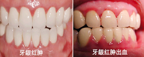 牙周病如何治疗?安庆有没有好的方法治疗牙周病